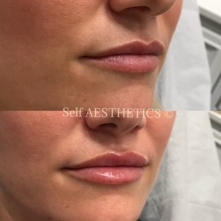Gorgeous Lip Fillers Brisbane's best north side cosmetic injector dermal fillers botox natural results skin needling anti ageing look younger lip fillers