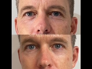 Botox for men Brisbane's best north side cosmetic injector dermal fillers botox natural results skin needling anti ageing look younger lip fillers