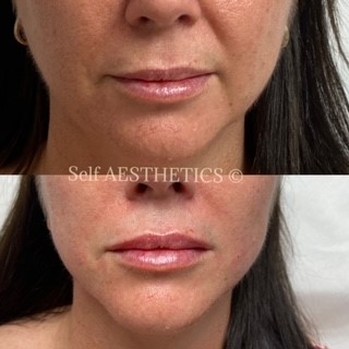Lip Fillers Brisbane's best north side cosmetic injector dermal fillers botox natural results skin needling anti ageing look younger lip fillers