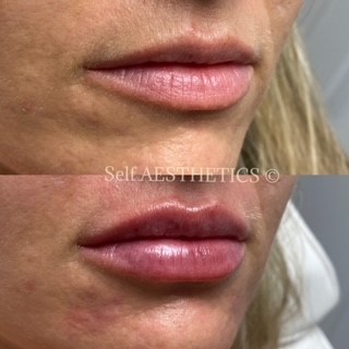 Beautiful Lips Brisbane's best north side cosmetic injector dermal fillers botox natural results skin needling anti ageing look younger lip fillers