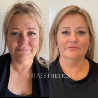 Brisbane's best north side cosmetic injector dermal fillers botox natural results skin needling anti ageing look younger lip fillers