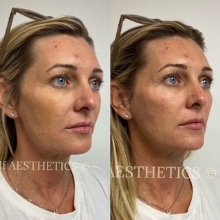 Anti aging Brisbane's best north side cosmetic injector dermal fillers botox natural results skin needling anti ageing look younger lip fillers