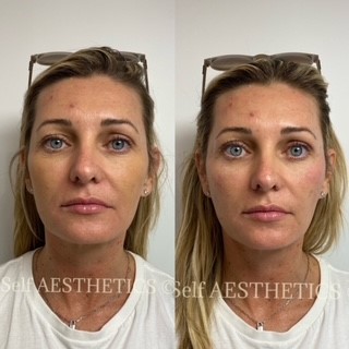 Refresh your skin Brisbane's best north side cosmetic injector dermal fillers botox natural results skin needling anti ageing look younger lip fillers
