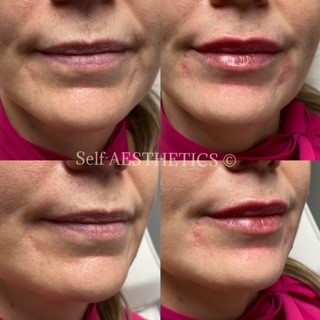 Look younger Brisbane's best north side cosmetic injector dermal fillers botox natural results skin needling anti ageing look younger lip fillers